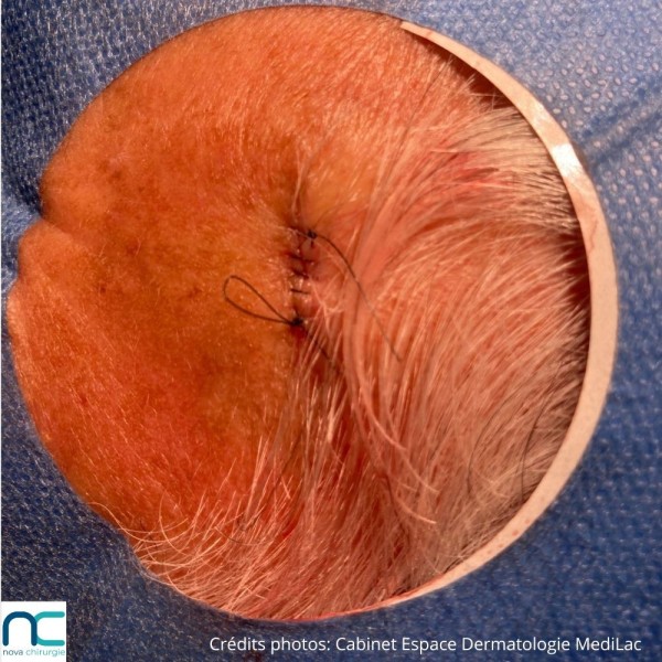 Nylon - dermatologue - chirurgie tissus superficiels