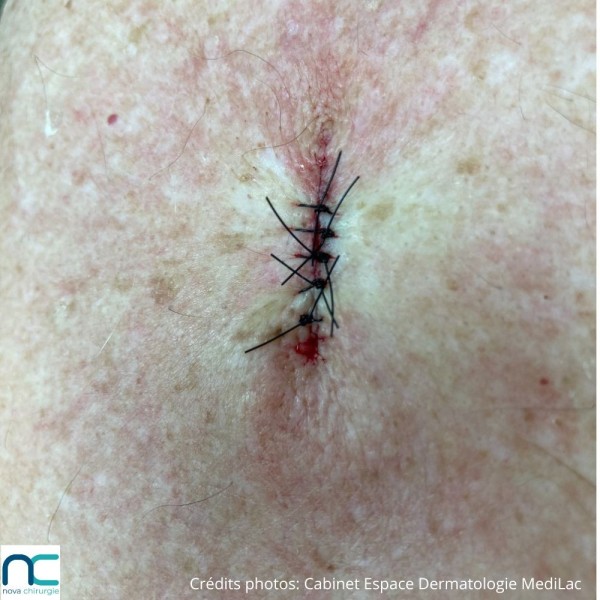 Nylon - dermatologue - chirurgie tissus superficiels