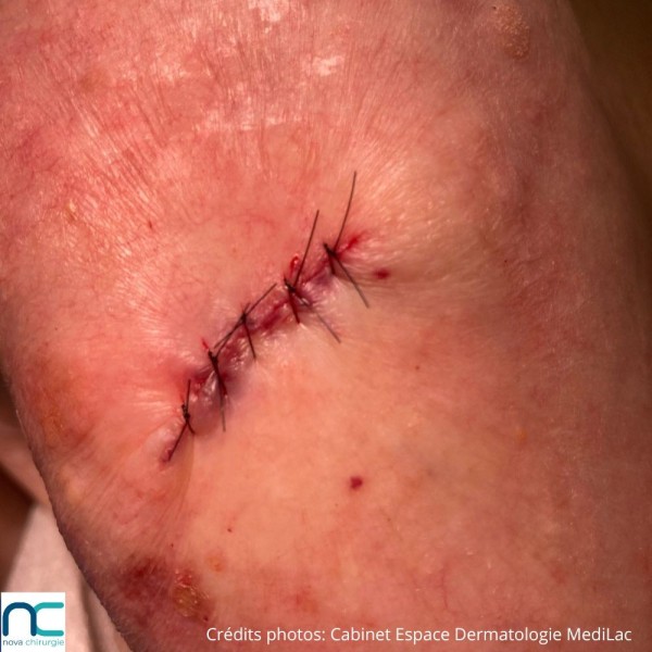 Nylon - dermatologue - chirurgie tissus superficiels