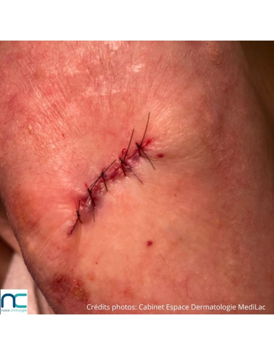 Nylon - dermatologue - chirurgie tissus superficiels