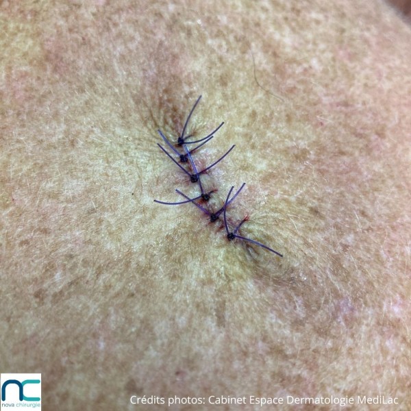 Utilisation du fil de suture PGC25 Atramat en chirurgie dermatologique, aiguille 3/8 reverse cutting, violet