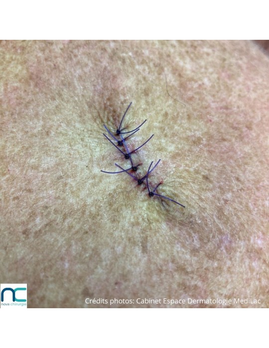 Utilisation du fil de suture PGC25 Atramat en chirurgie dermatologique, aiguille 3/8 reverse cutting, violet