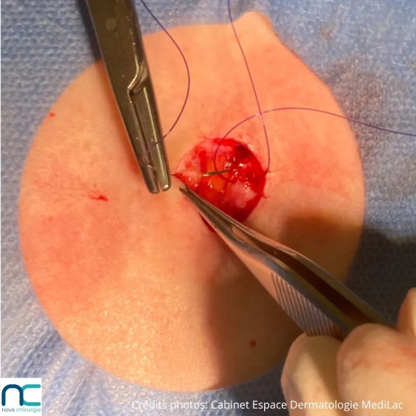 Utilisation du fil de suture PGC25 Atramat en chirurgie dermatologique, aiguille 3/8 reverse cutting