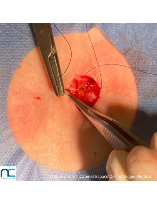 Utilisation du fil de suture PGC25 Atramat en chirurgie dermatologique, aiguille 3/8 reverse cutting